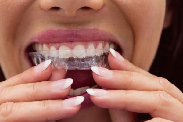 黃淳逸醫師專欄｜透明牙套是近年來流行的一種矯正方式，不一定適合你！